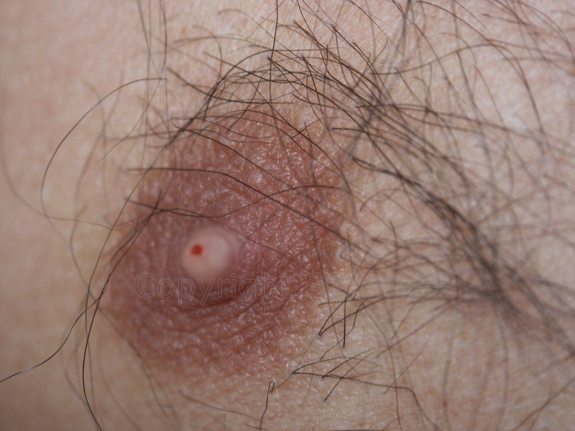 Runners Nipple 
 DCF 1.0 
 Keywords: runner's nipple, marathon running, sore, man's hairy nipple, blister